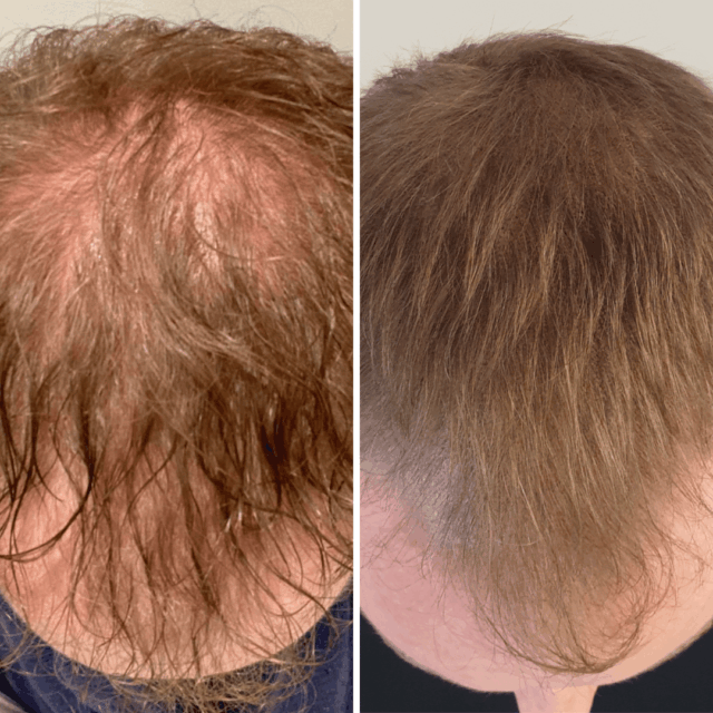 SMP Thickening before afters (12)