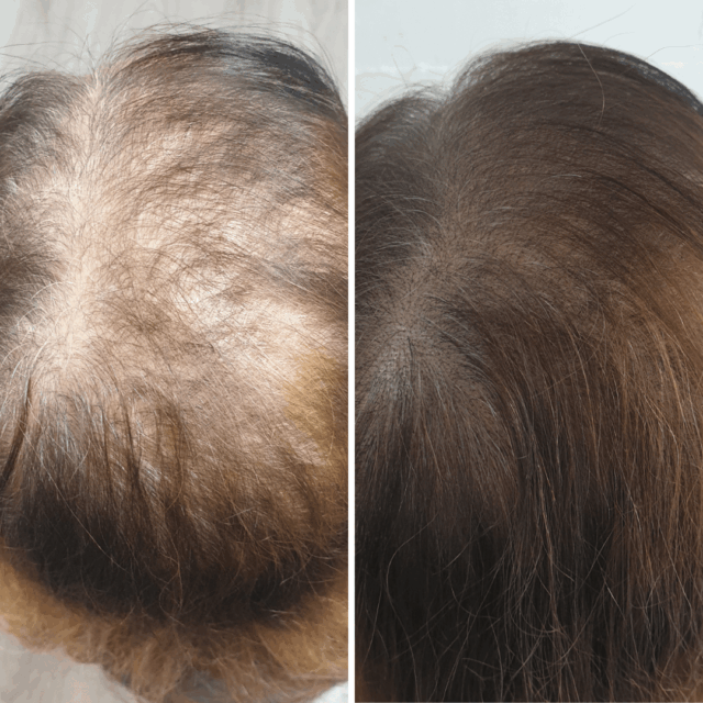 SMP Thickening before afters (14)