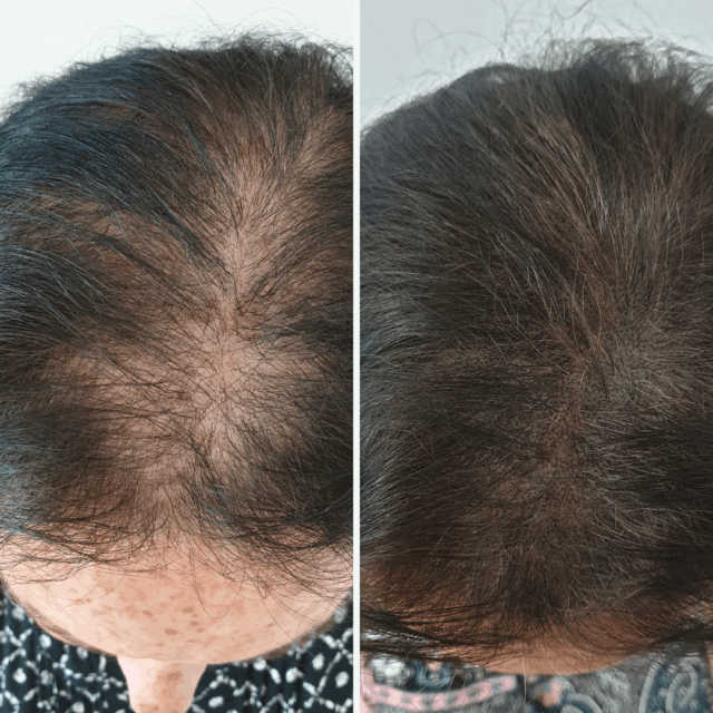 SMP Thickening before afters (15)