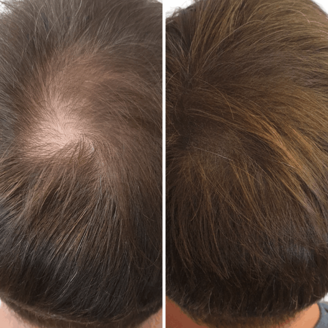 SMP Thickening before afters (19)