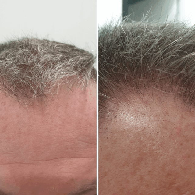 SMP Thickening before afters (20)