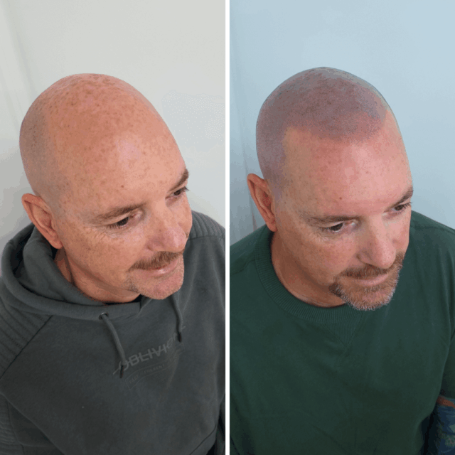 Scalp micro hairline restoration