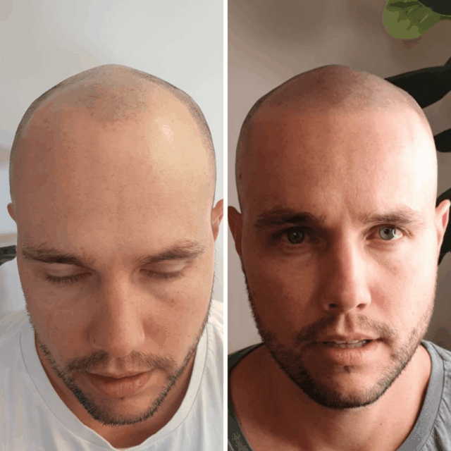 Scalp micro shaved look