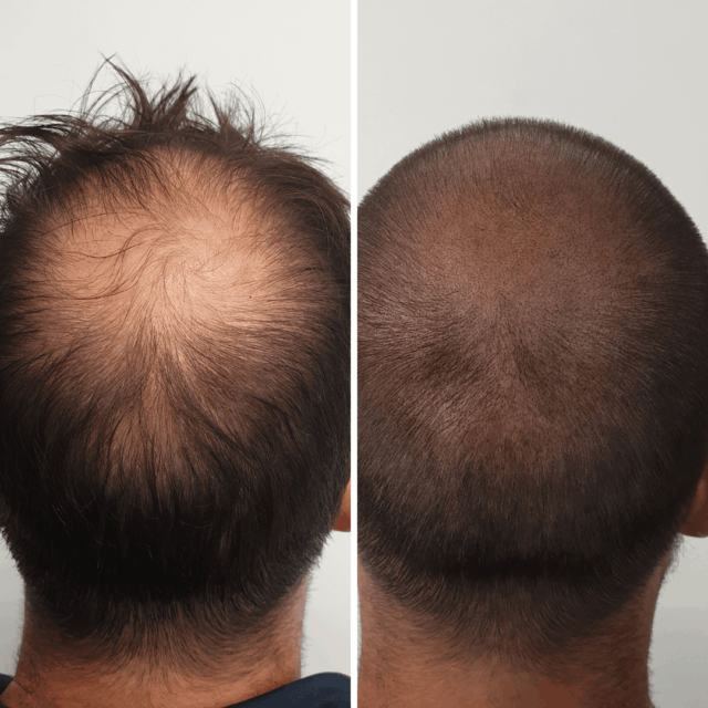 Scalp micropigmentation density thickening treatment