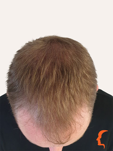 scalp micropigmentation hair density