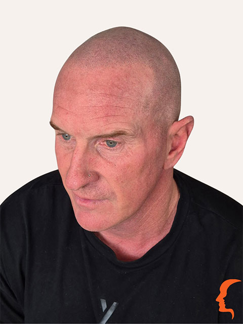 scalp pigmentation buzz-cut