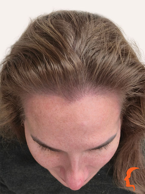 scalp pigmentation hair thinning