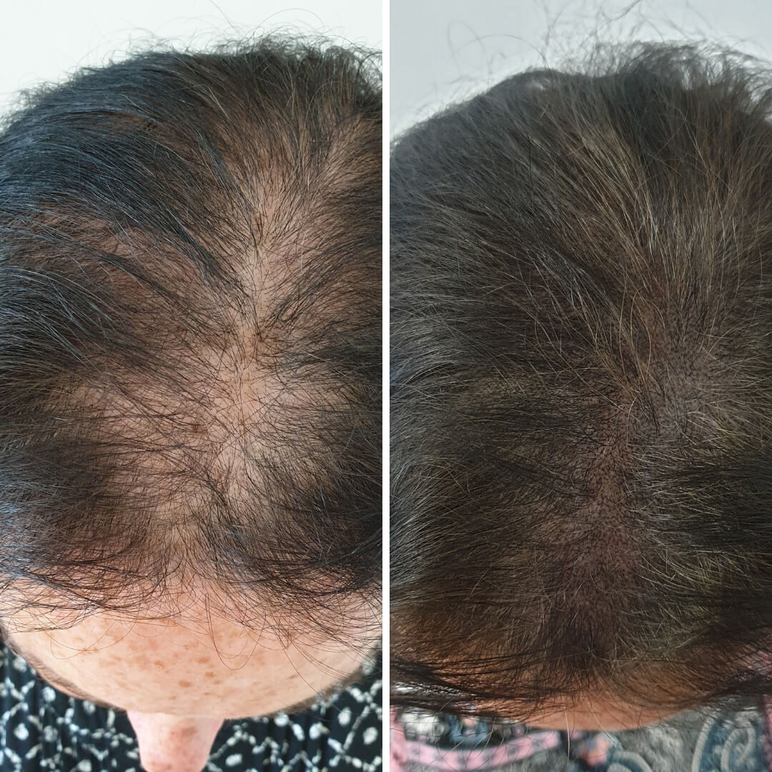 female hair thinning-before and after smp