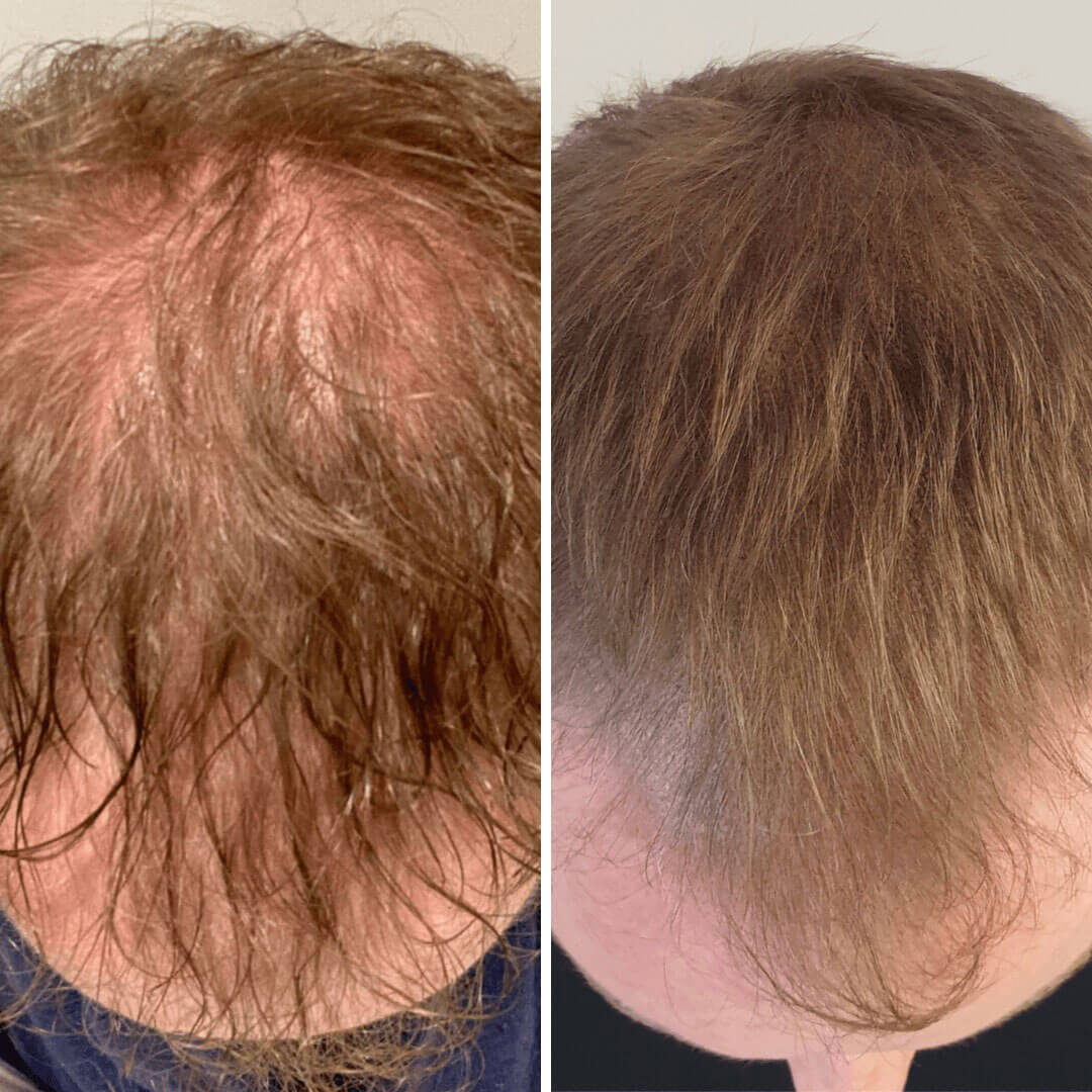 Gold Coast Before And After Hair Loss And Thinning