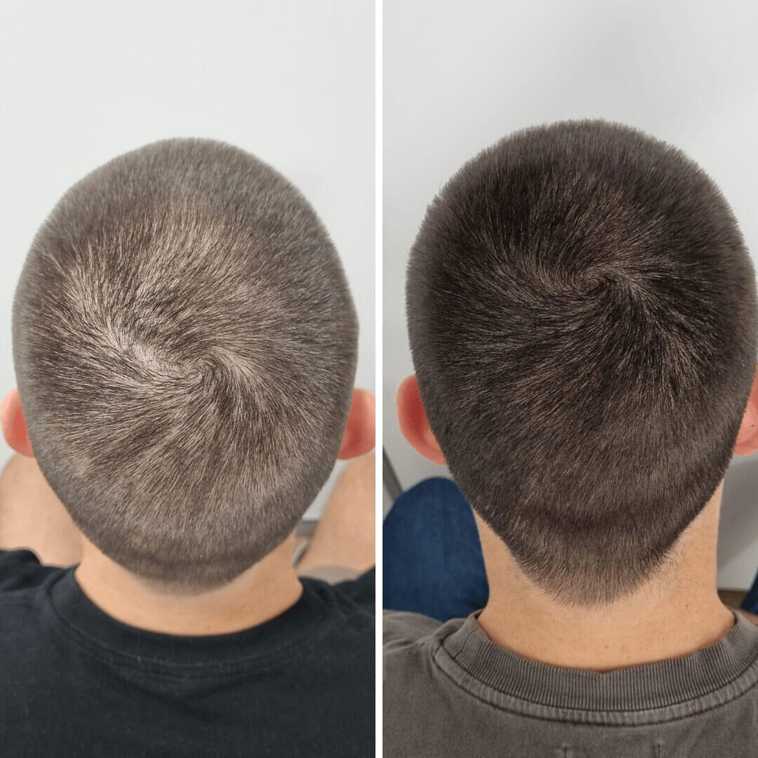 Hair Loss And Thinning Before And After Gold Coast