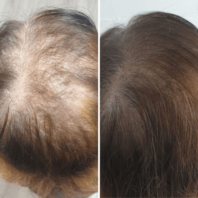 hairline solutions scalp micropigmentation aftercare