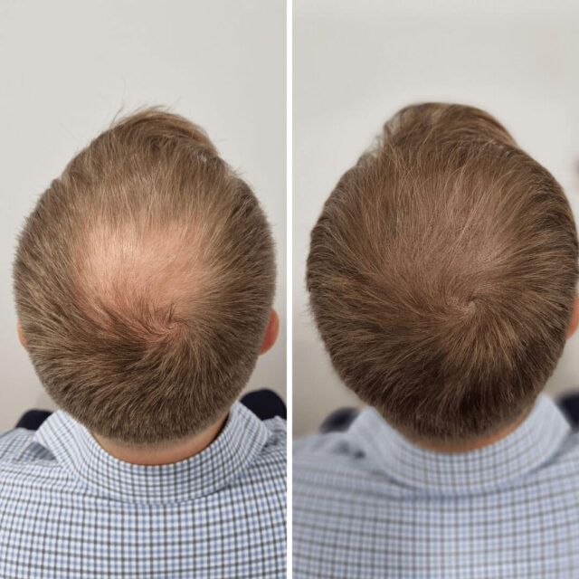 scalp micropigmentation pre-care men